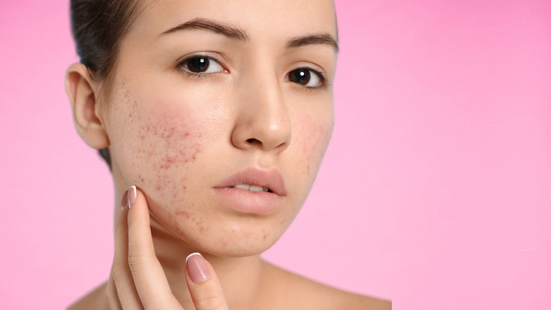 Before using InfraGlow Rejuvenation Device – visible signs of dull and uneven skin.